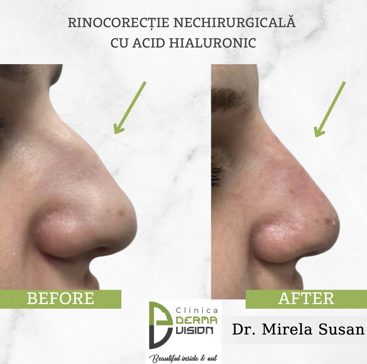 before-after rinocorectie