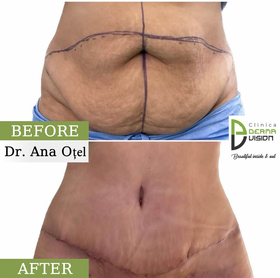 before-after1 Abdominoplastia