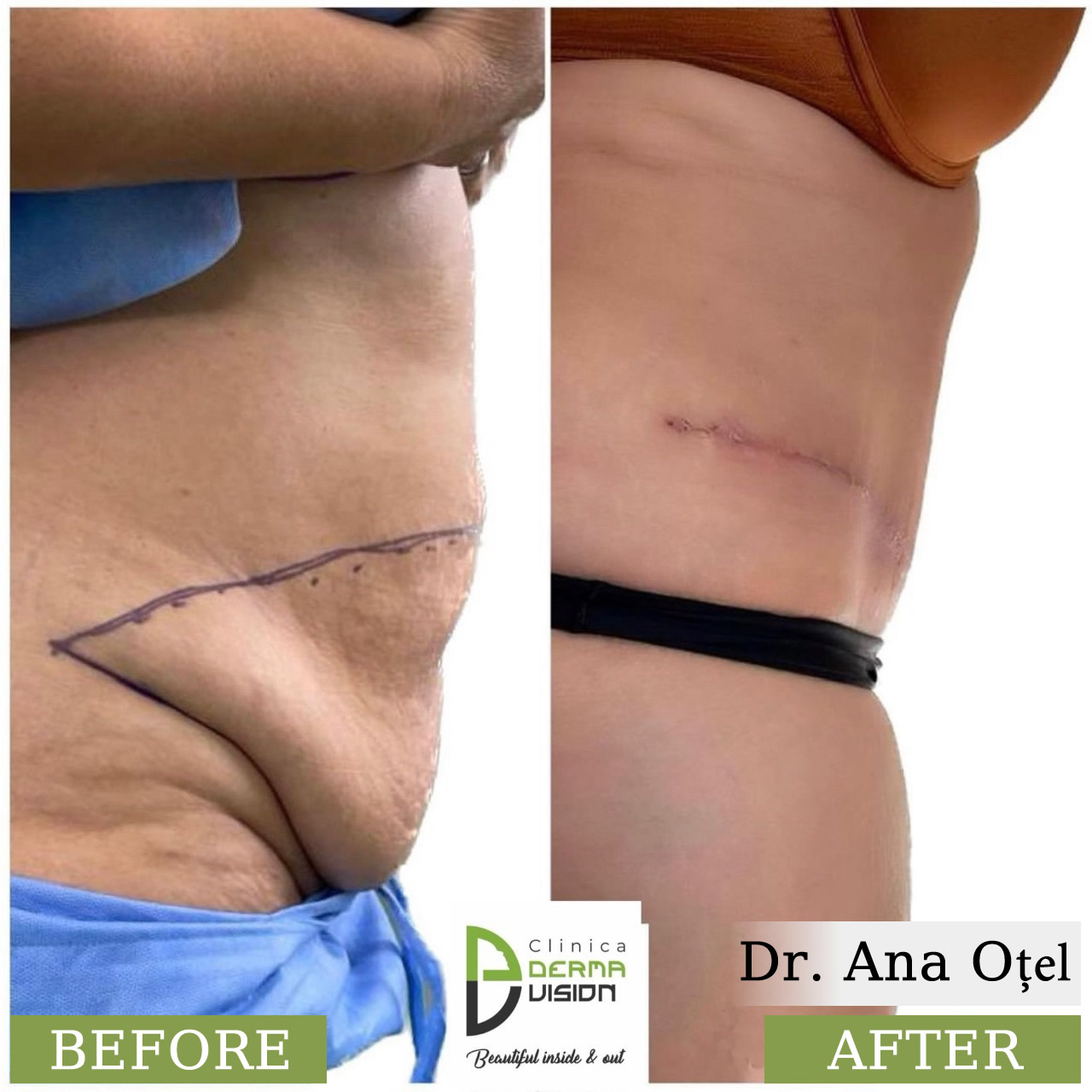 before-after2 Abdominoplastia
