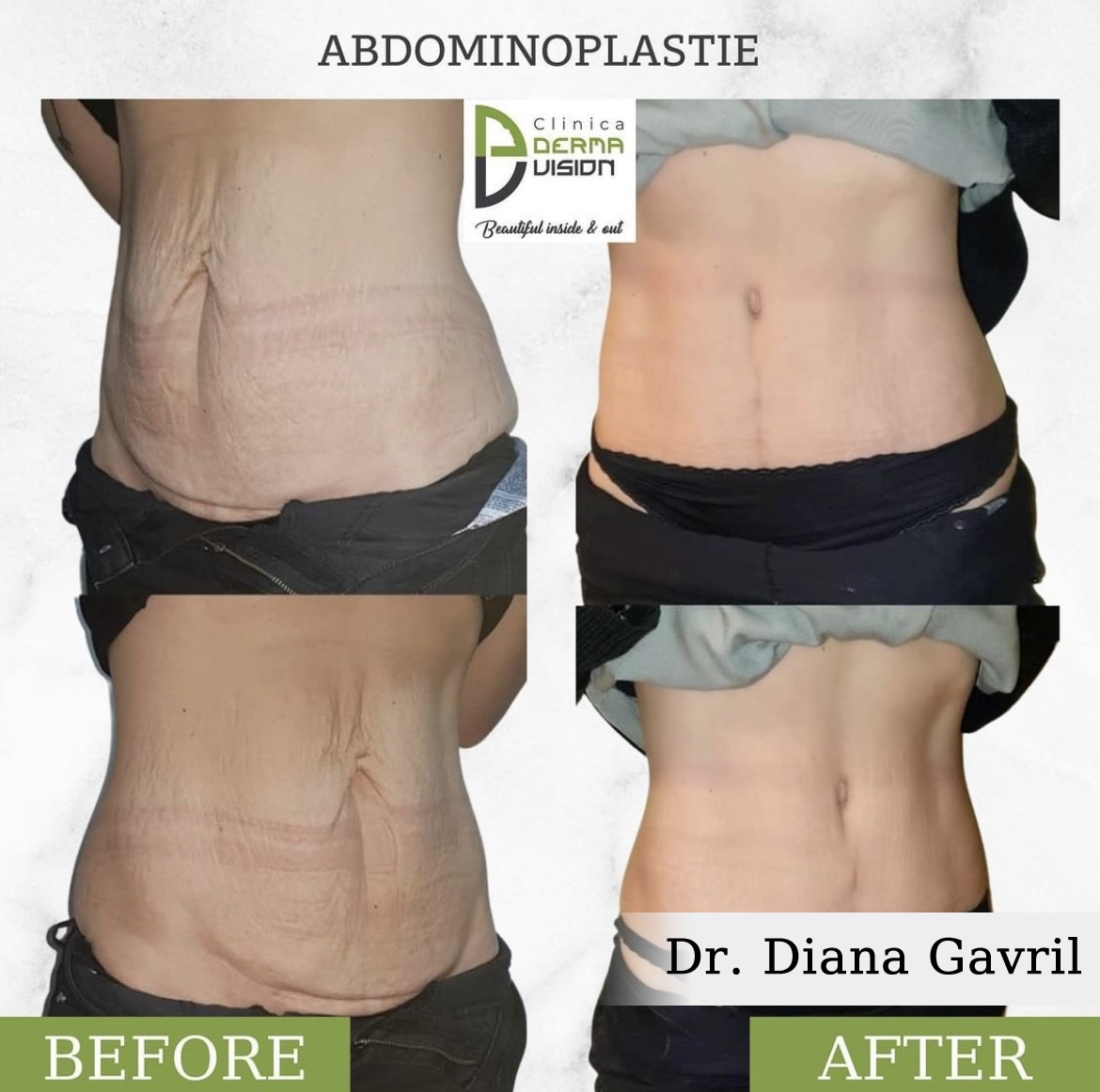 before-after3 Abdominoplastia