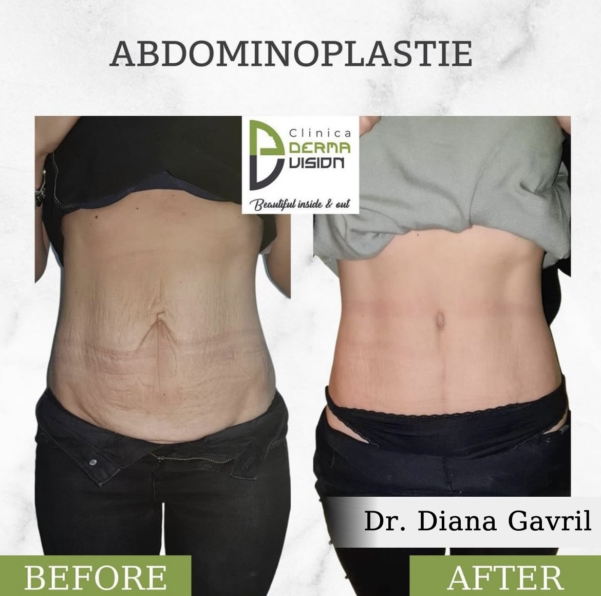 before-after4 Abdominoplastia