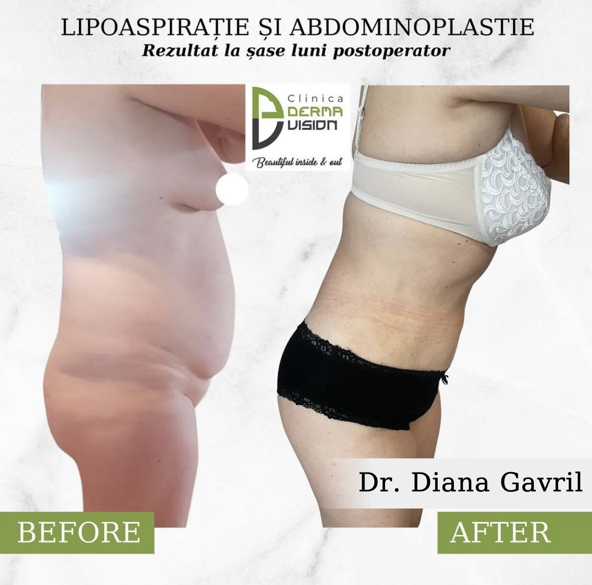 before-after1 Abdominoplastie
