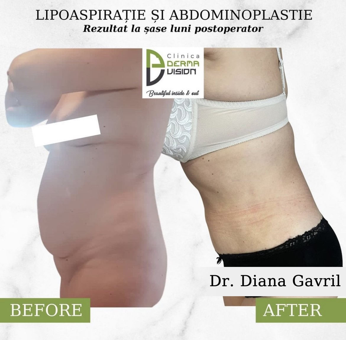 before-after2 Abdominoplastie