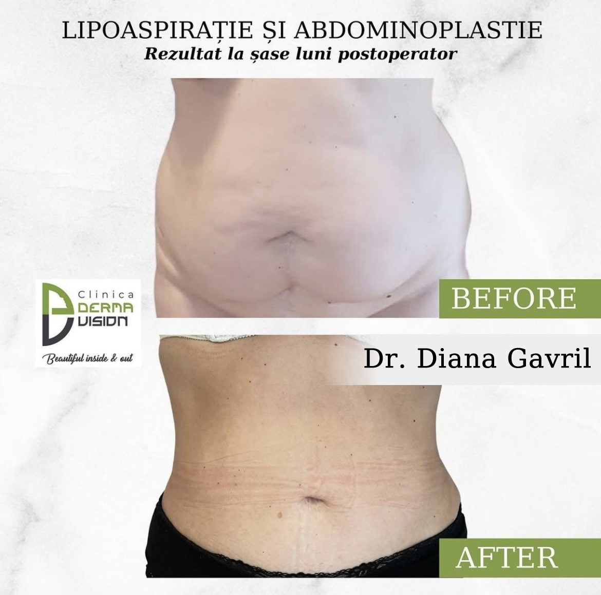 before-after3 Abdominoplastie