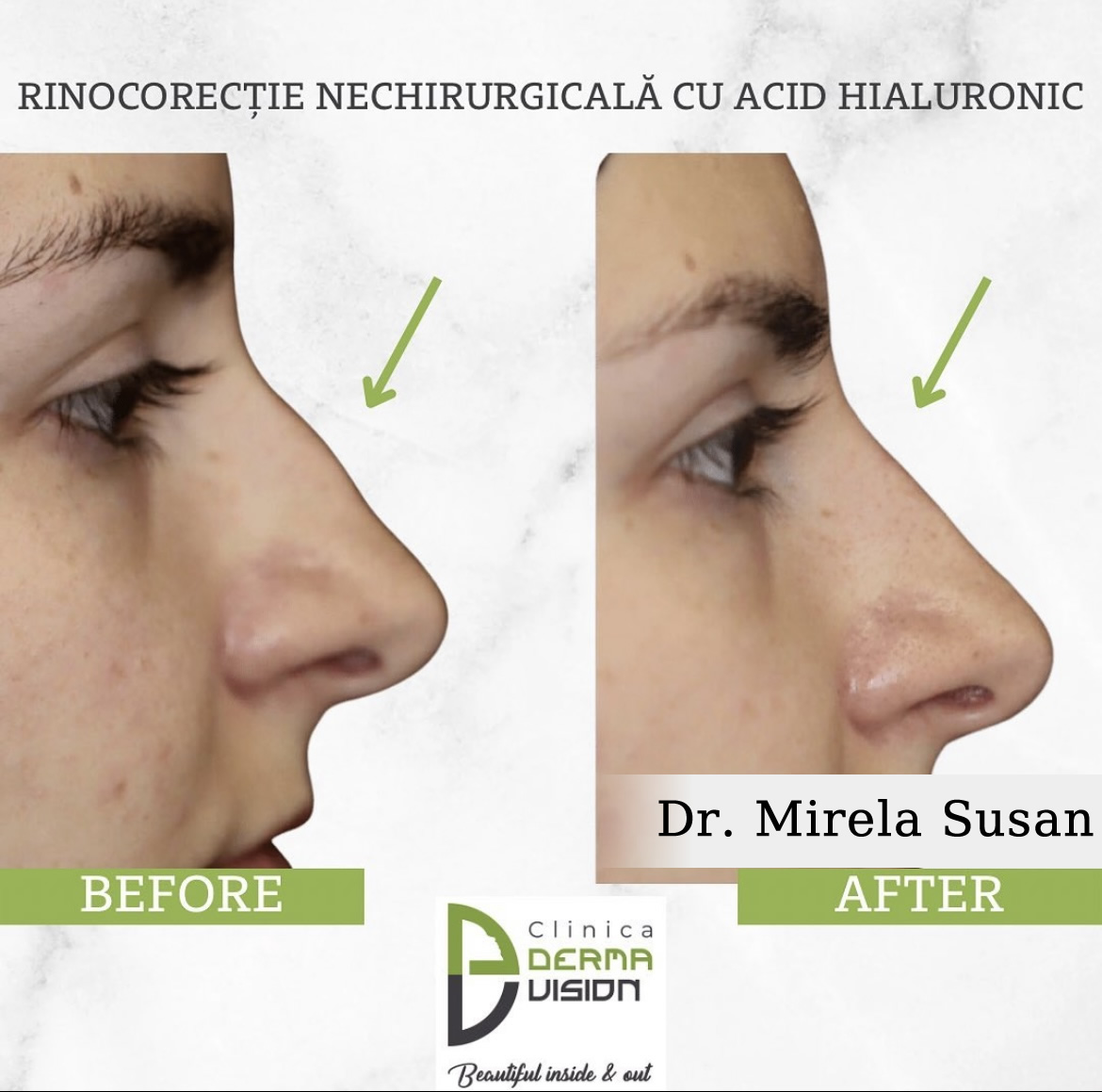 before-after acid hialuronic
