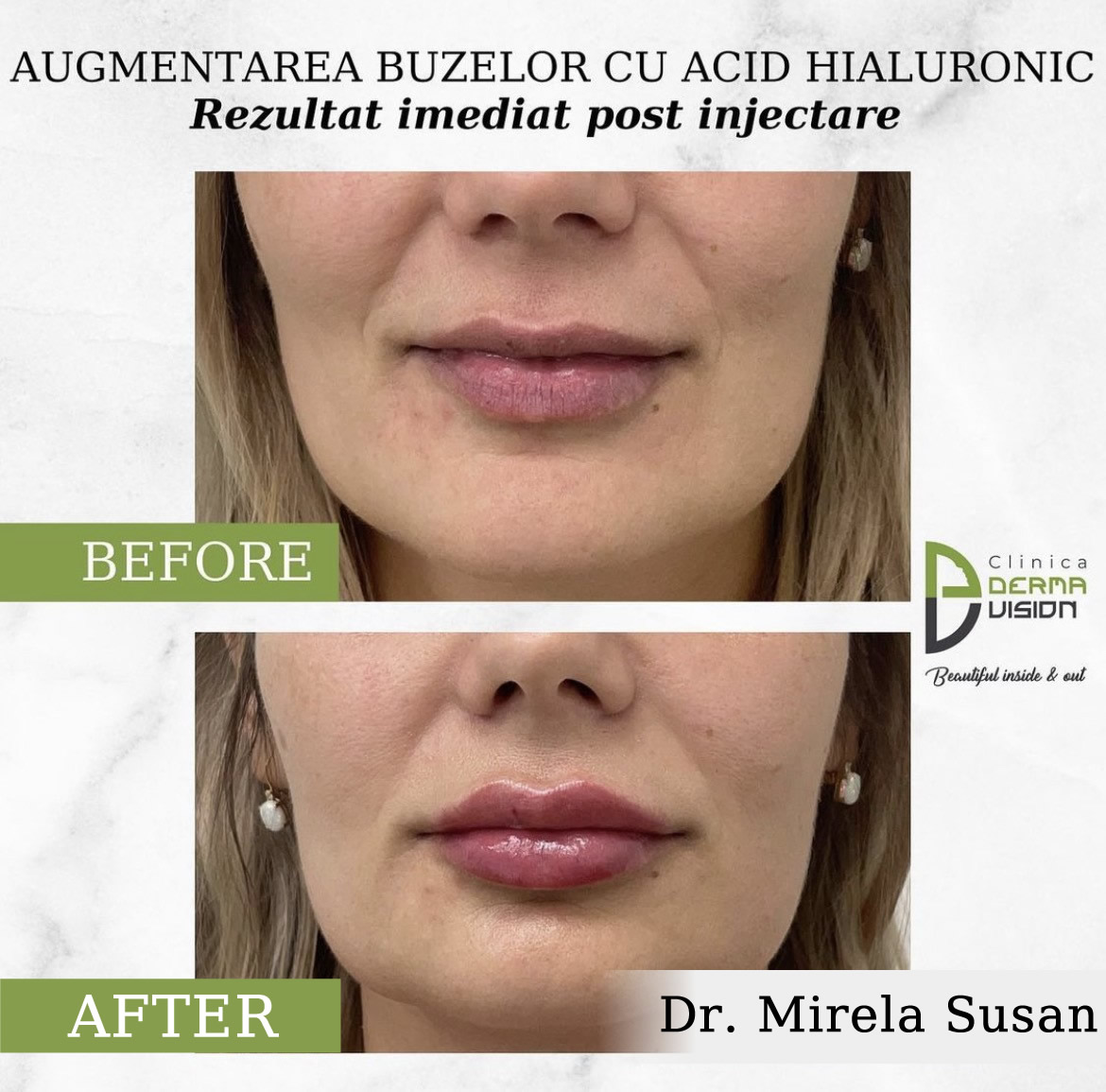 before-after acid hialuronic cluj