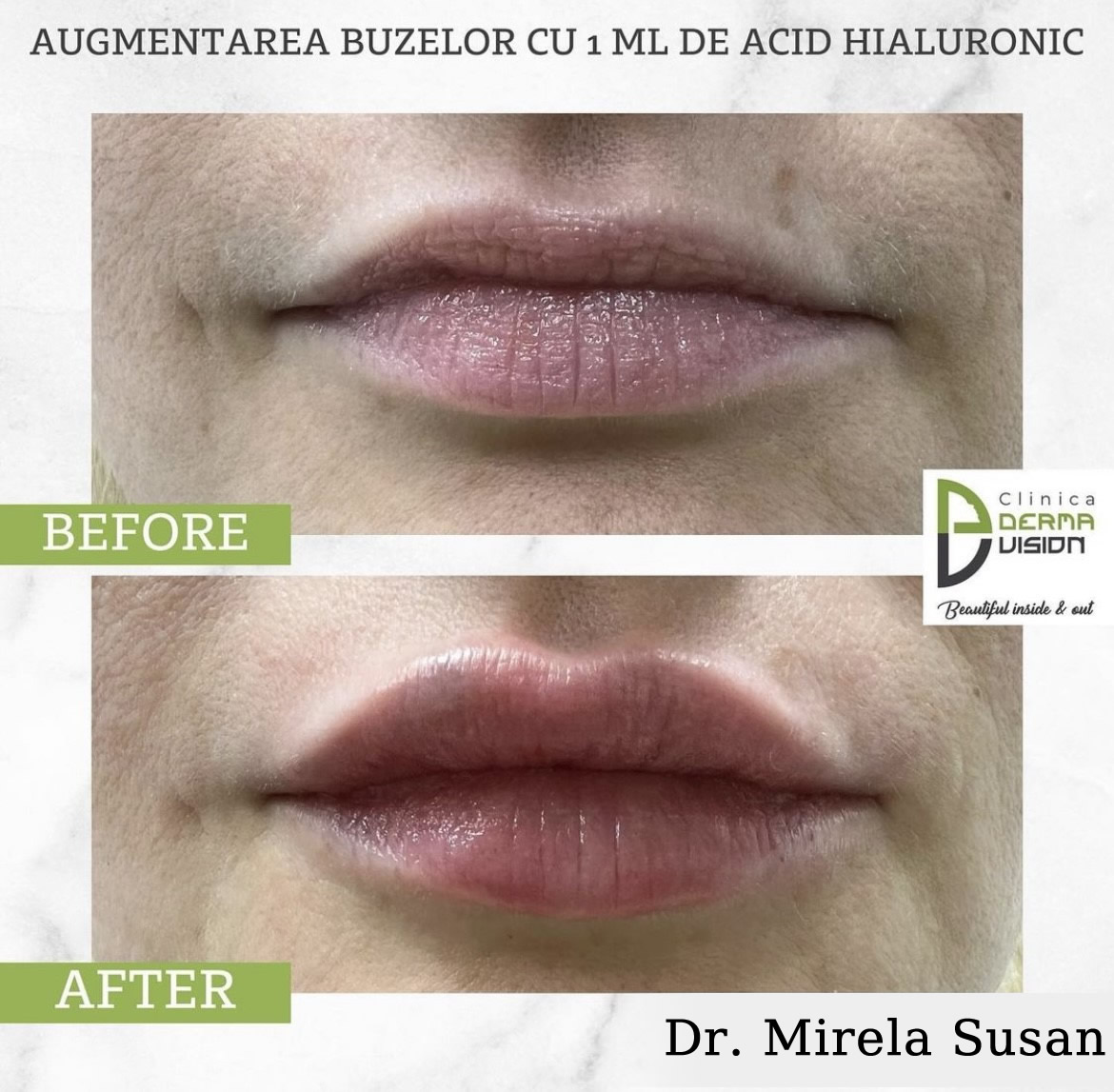 before-after acid hialuronic