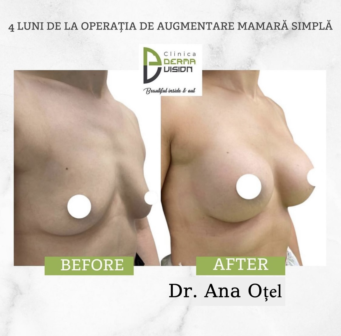 before-after1 augmentare