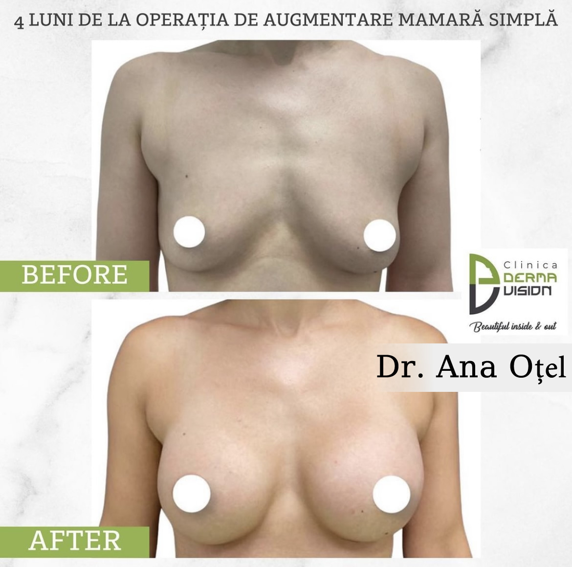 before-after3 augmentare