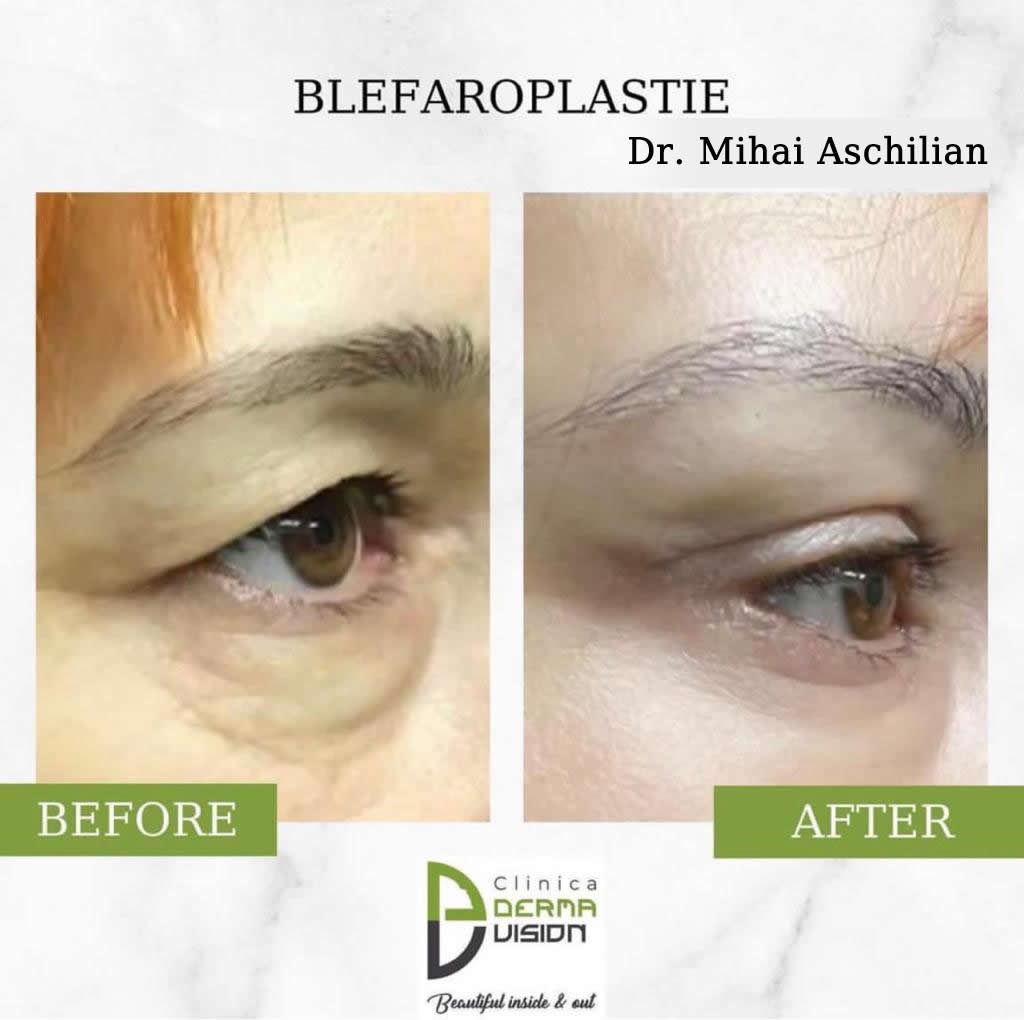 before-after1 blefaroplastie