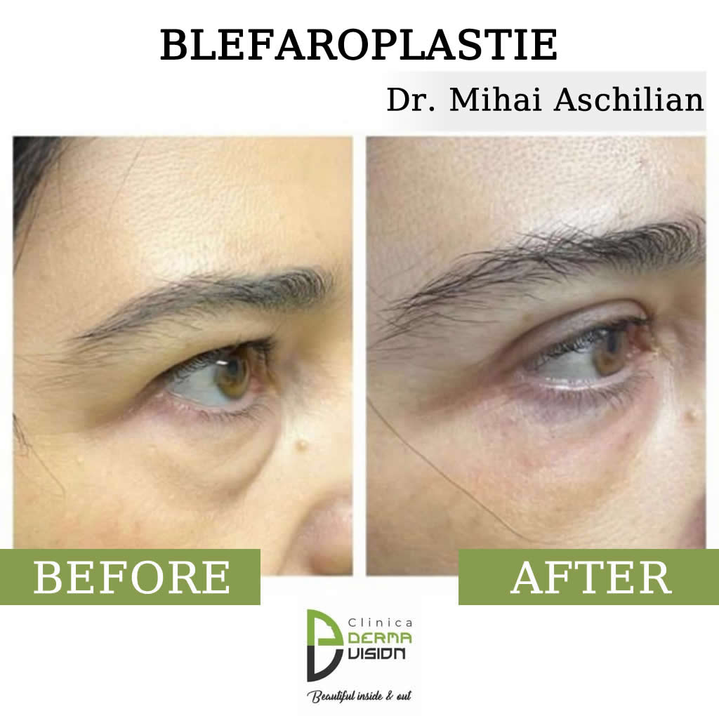 before-after2 blefaroplastie