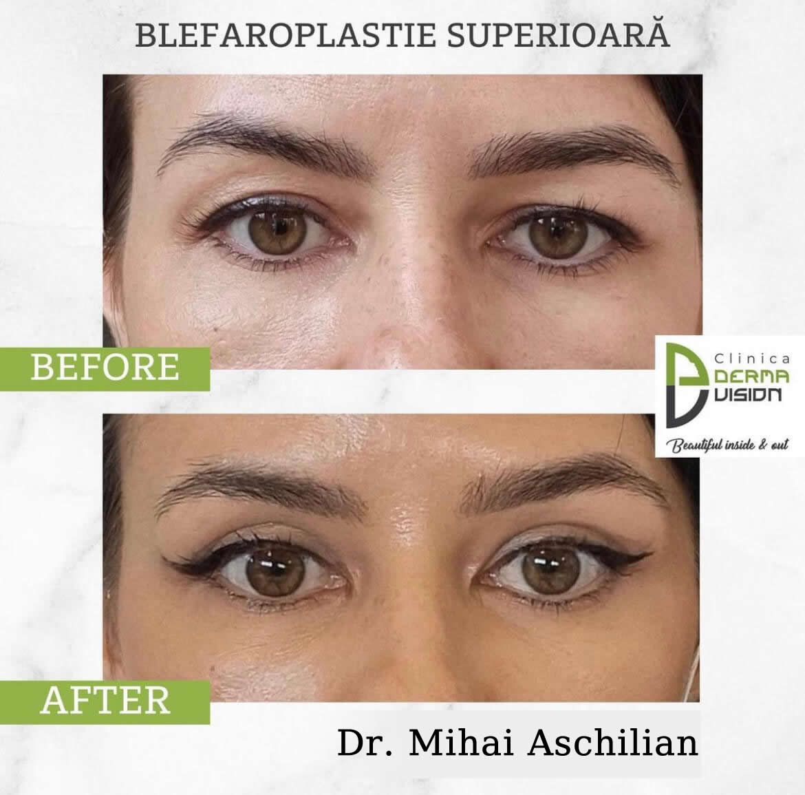 before-after3 blefaroplastie