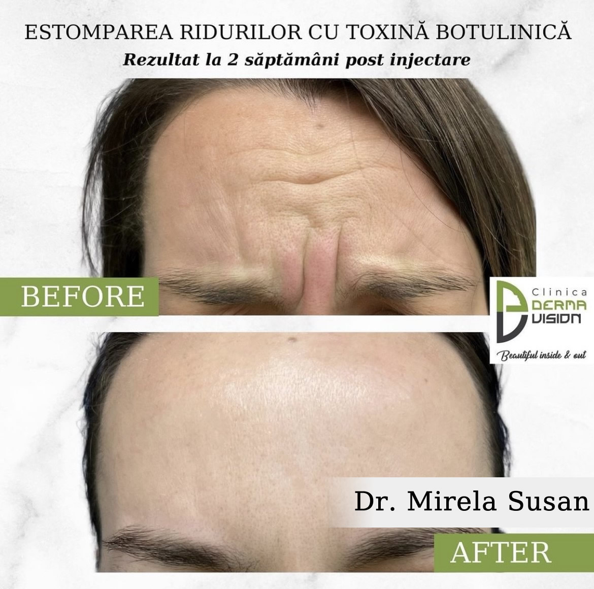 Injectare cu Botox Cluj