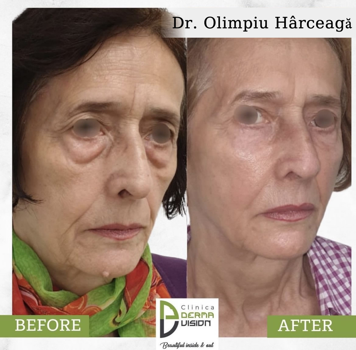 before-after1 lifting facial