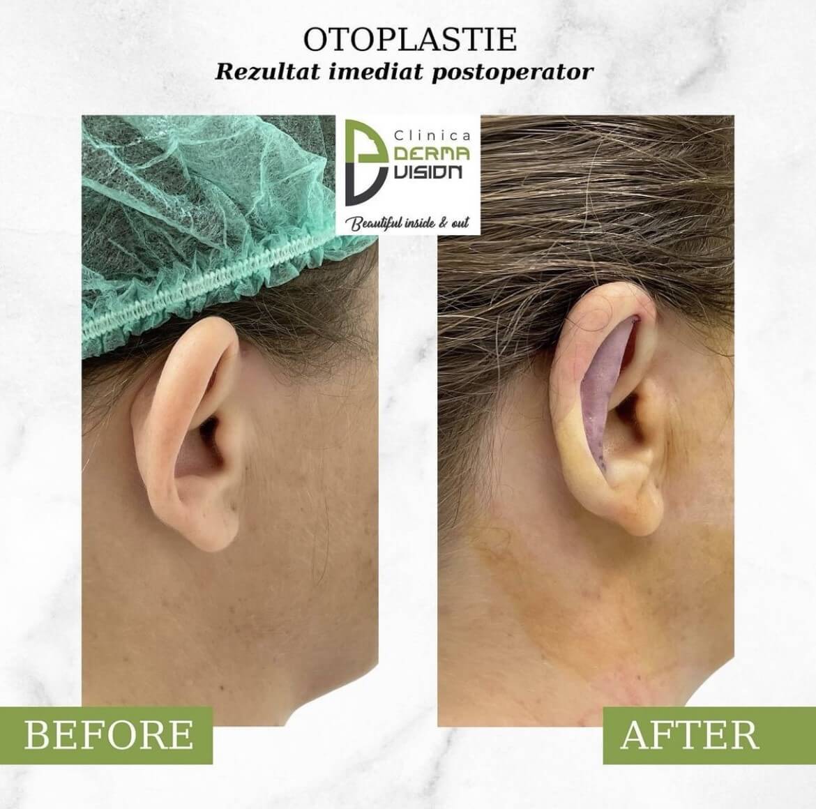 before-after1 otoplastie