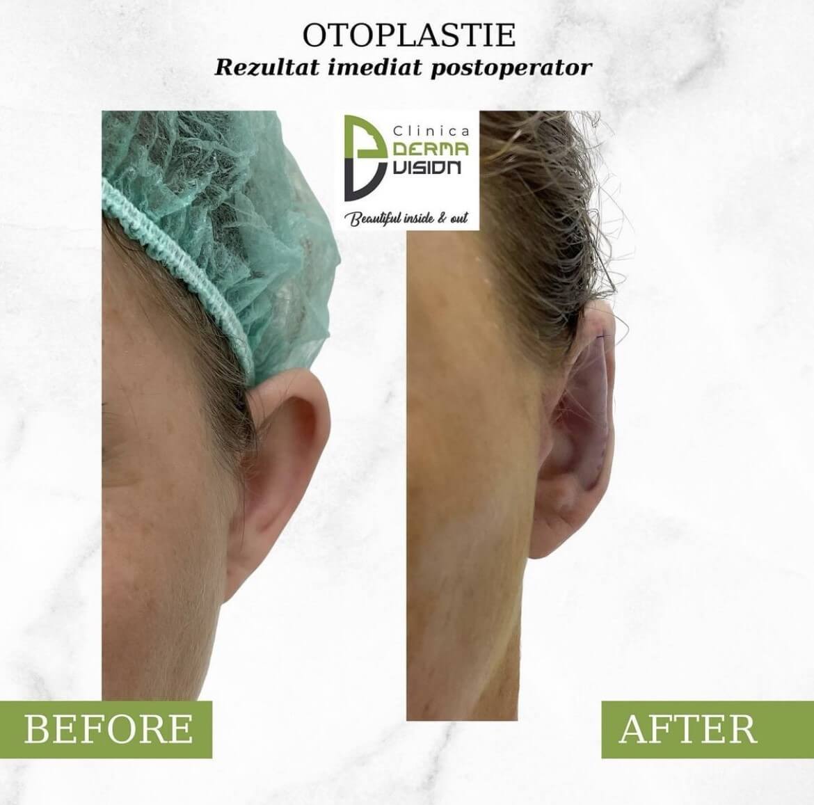 before-after6 otoplastie